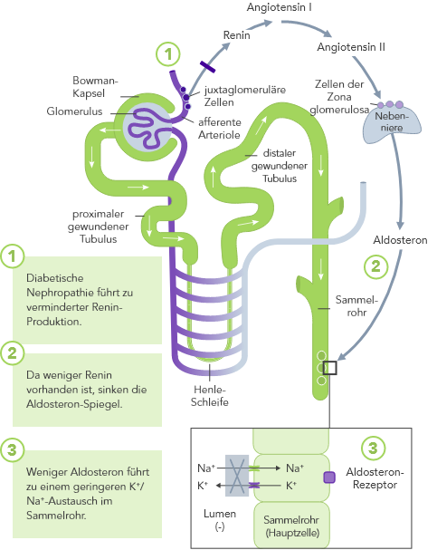 Diagram: diabetic nephropathy leads to reduced renin and lower K+ excretion