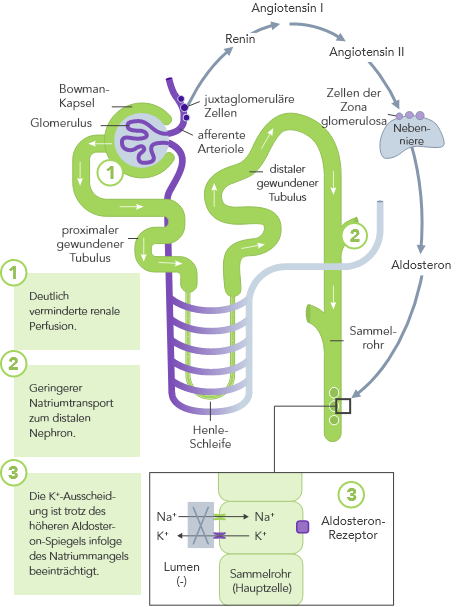 Diagram: Heart failure-induced hyperkalaemia